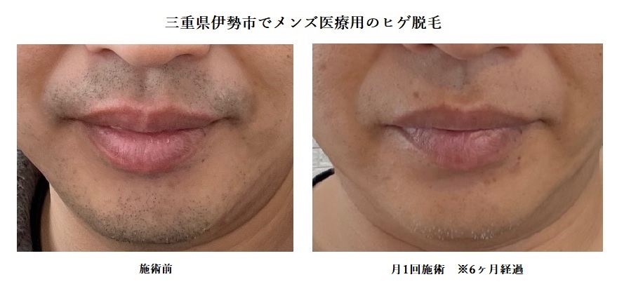 三重県伊勢市でメンズ医療用のヒゲ脱毛